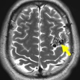 未破裂脳動静脈奇形 AVM1